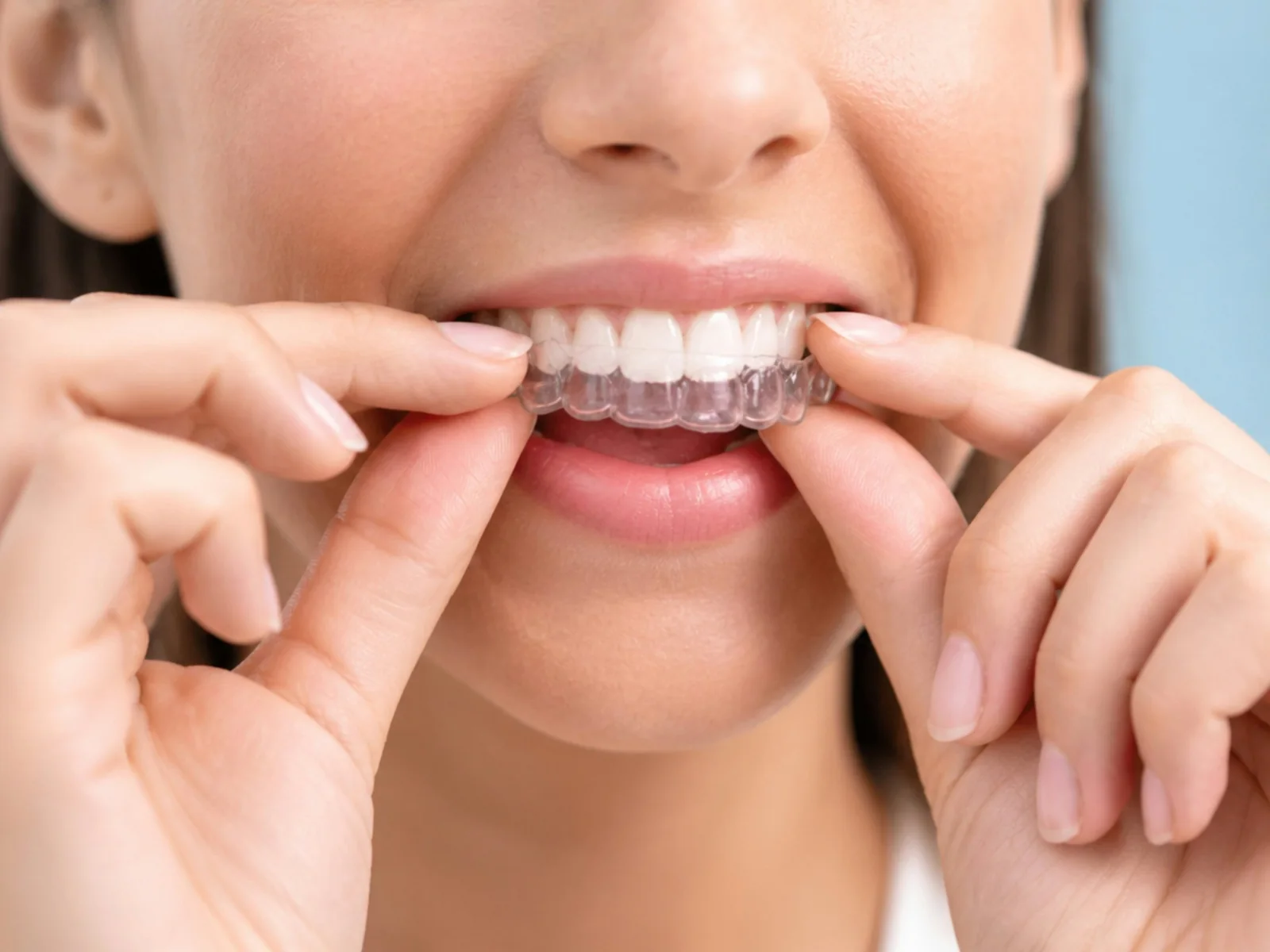 Clear aligner being fitted