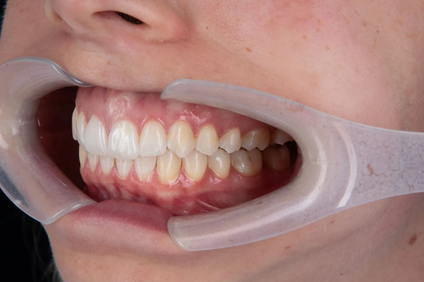 Clear aligner patient, left side