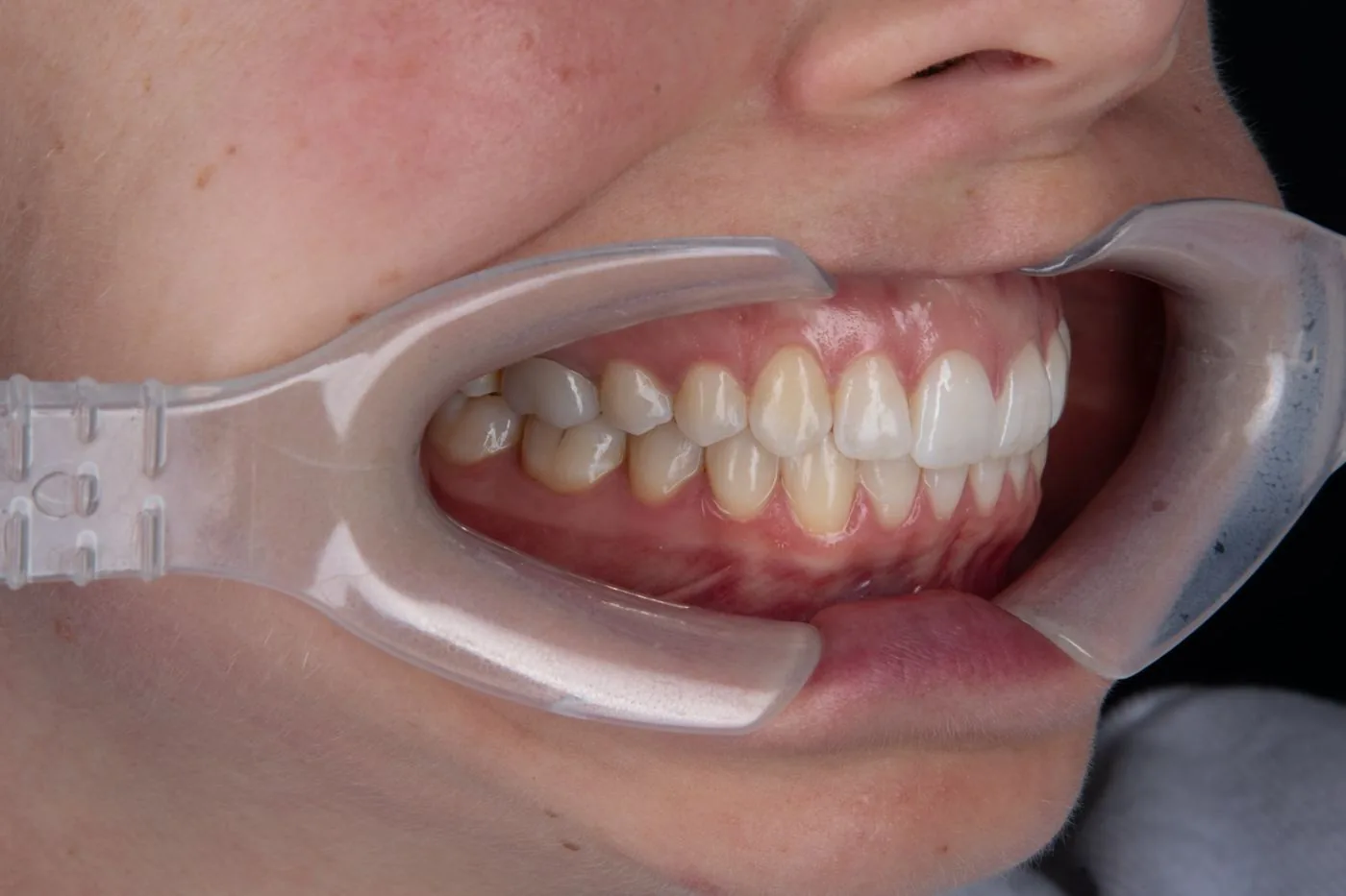 Clear aligner patient, right side