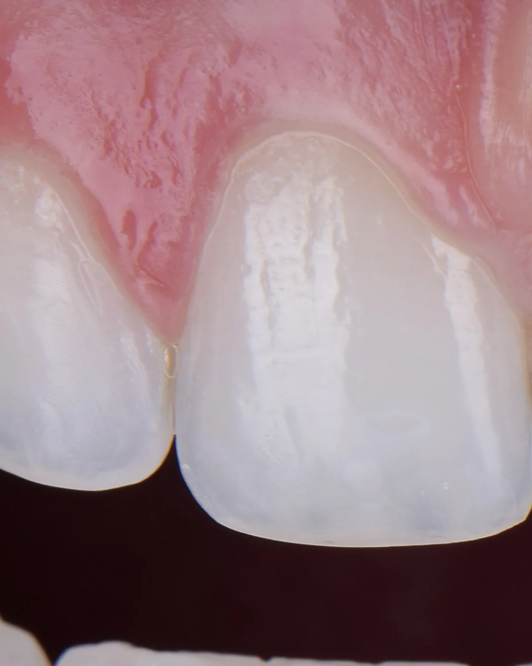 Composite bonding, close-up detail