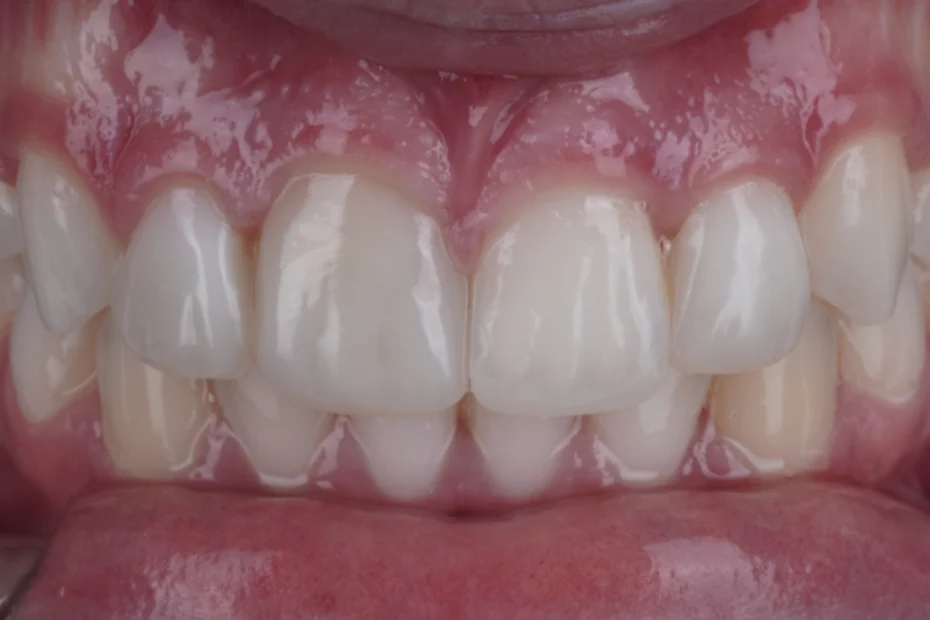 Composite bonding after orthodontics, after
