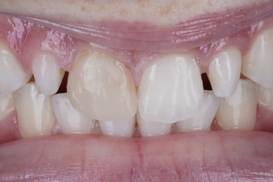 Composite bonding after orthodontics, before