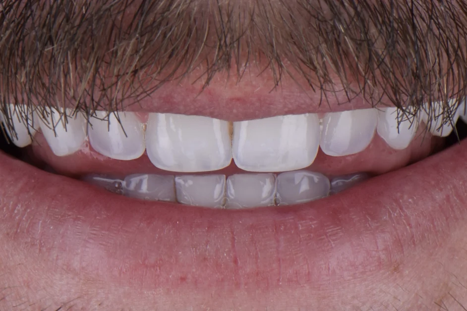 Composite bonding after clear aligners, after