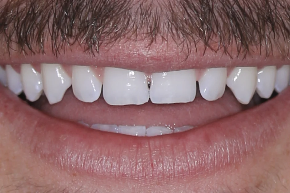 Composite bonding after clear aligners, before