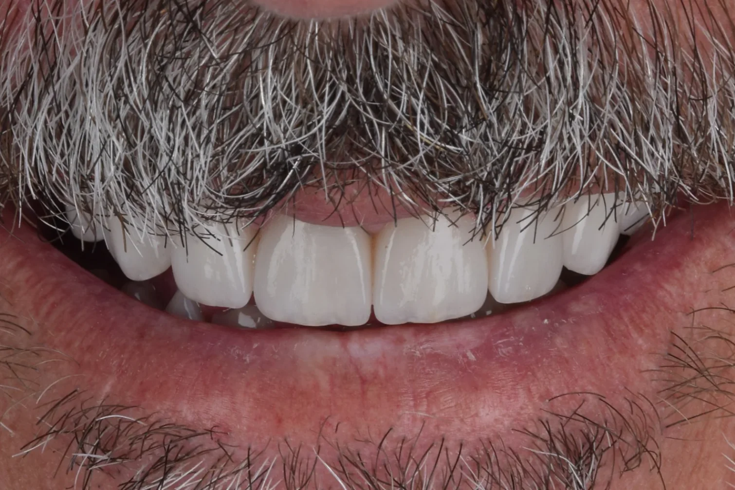 Porcelain veneers smile makeover, after