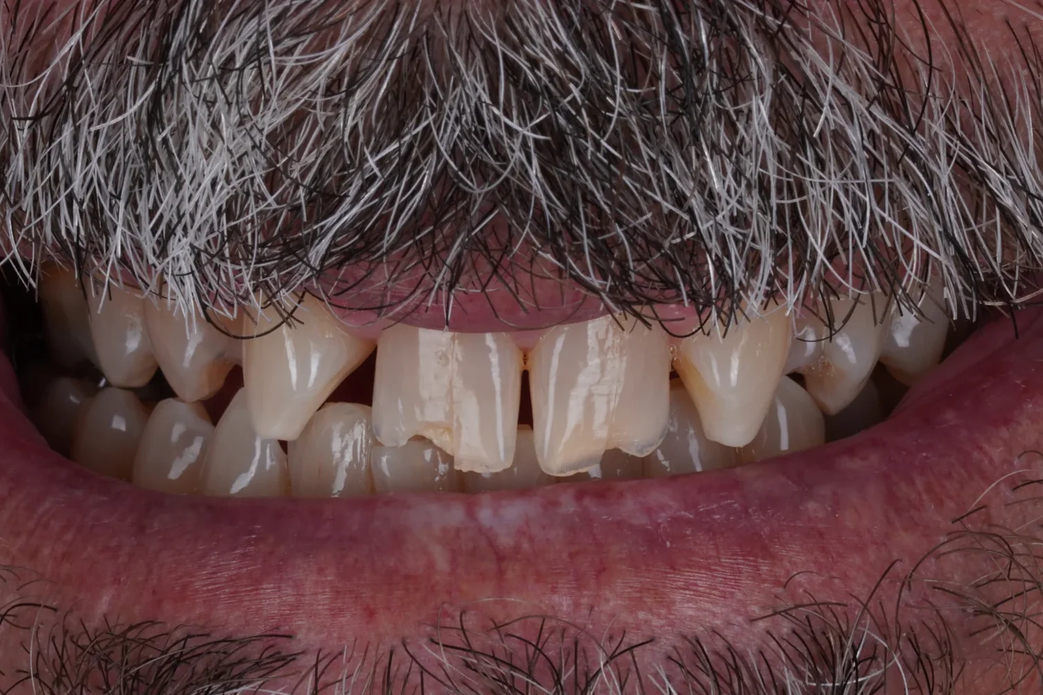 Porcelain veneers smile makeover, before