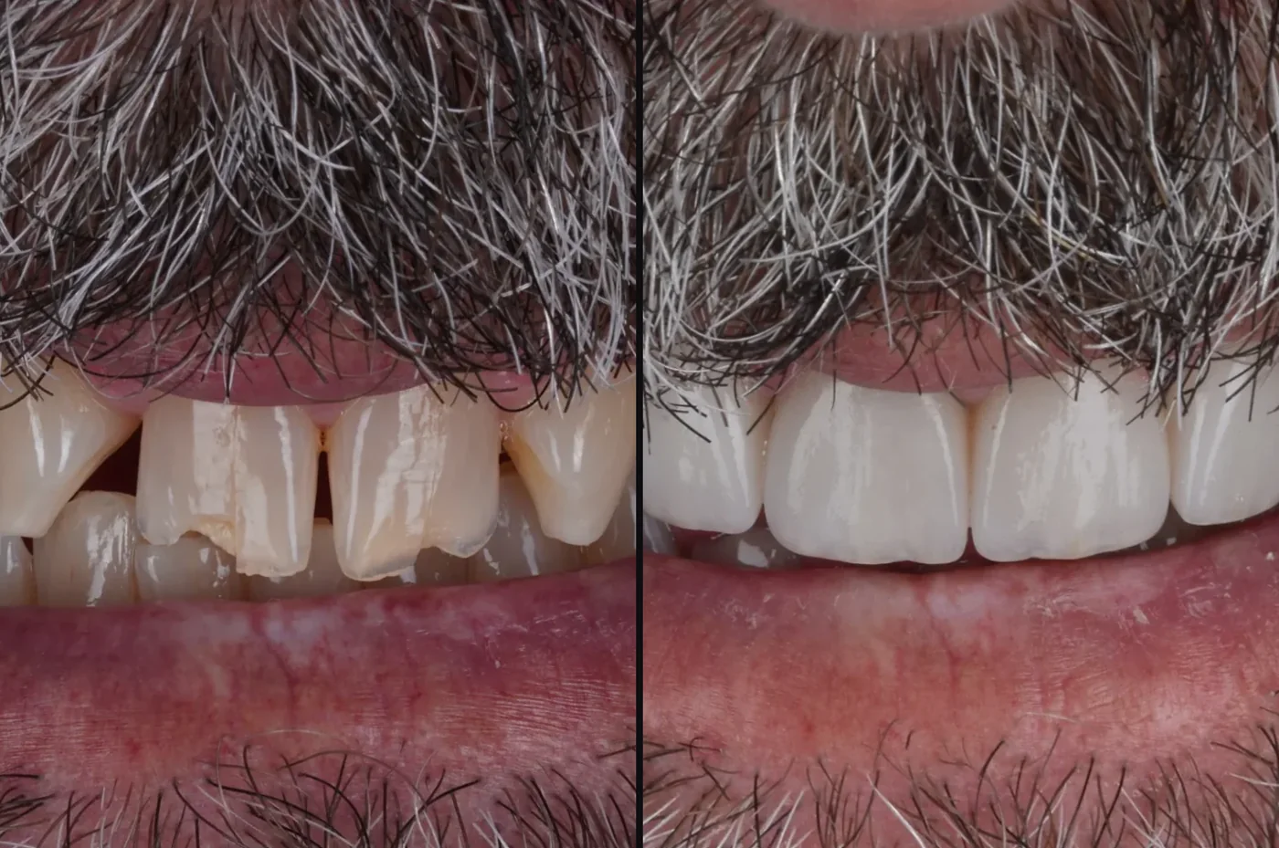 Porcelain veneers on the laboratory model