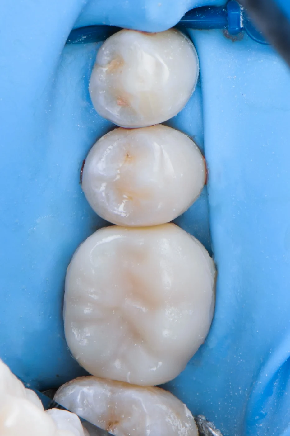 Ceramic restorations bonded under rubber dam