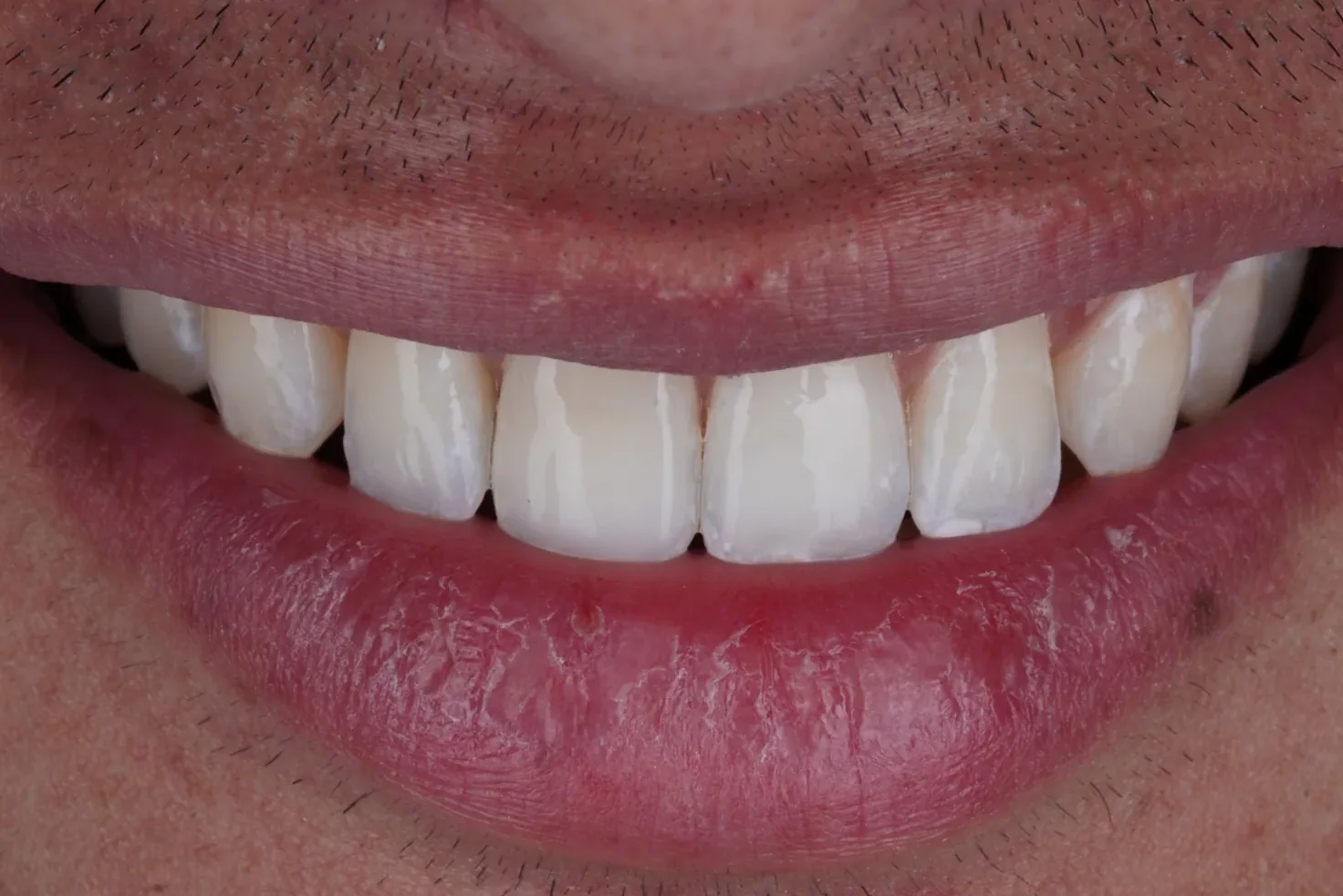 White and brown spot treatment, after