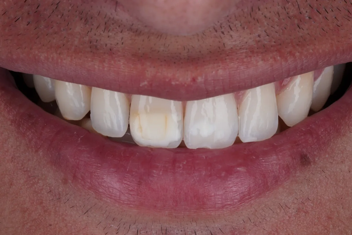 White and brown spot treatment, before