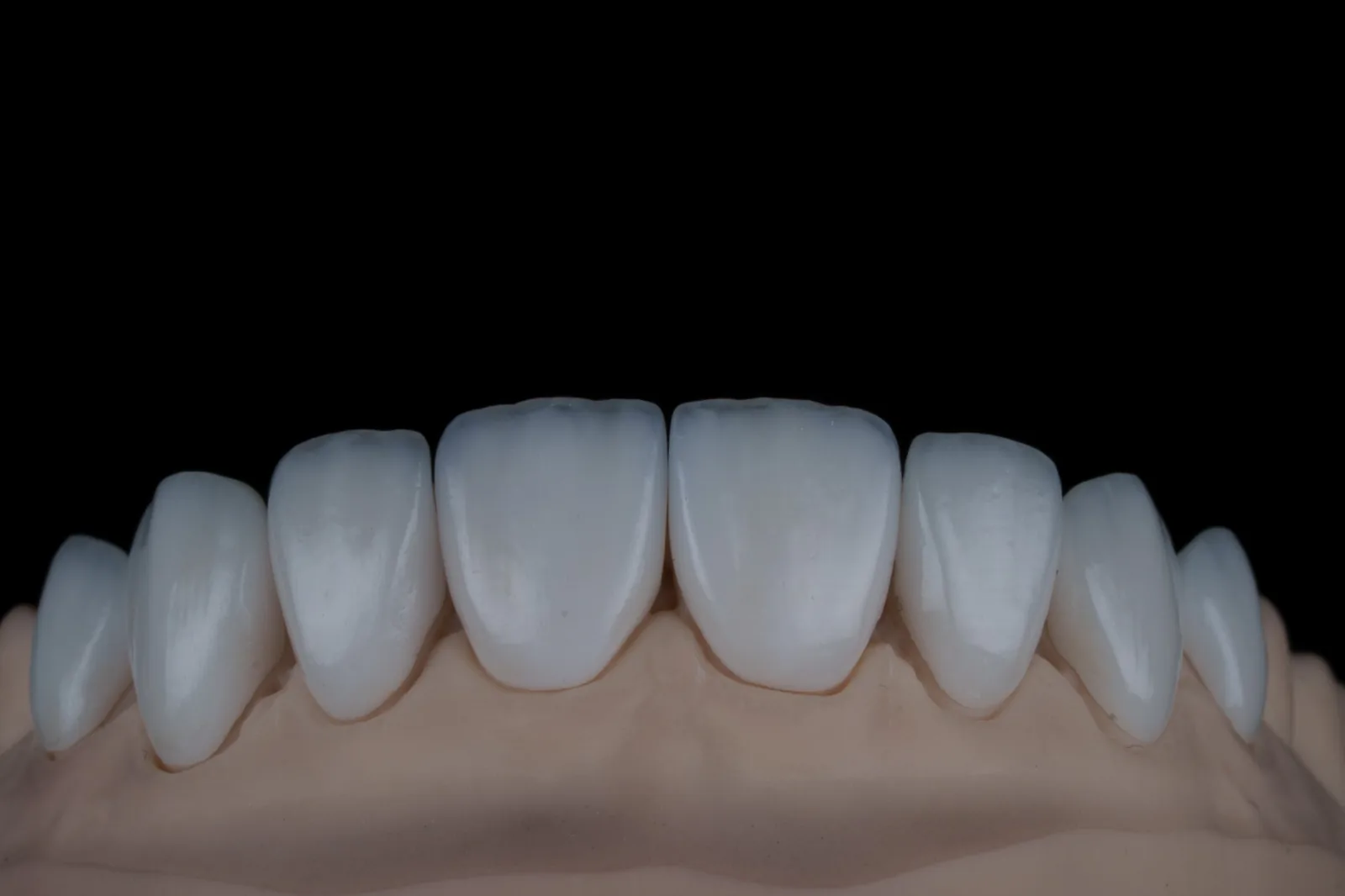 The same veneers on the laboratory model