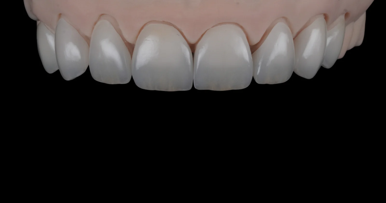 Porcelain veneers on the laboratory model