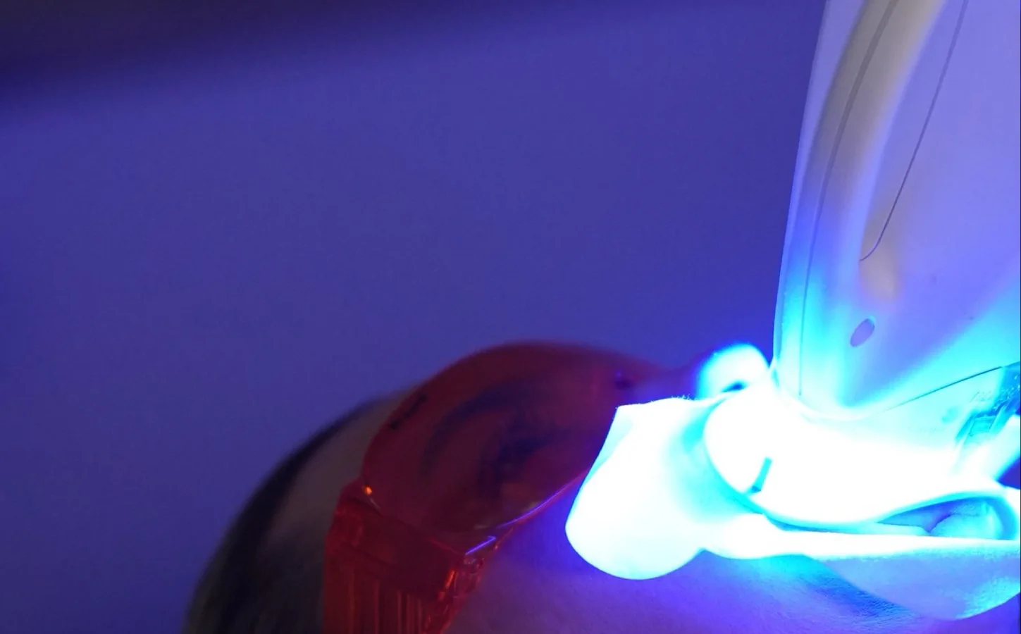Zoom whitening in progress, with eye protection